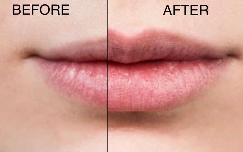 A before and after shot of a woman's lips after undergoing a lip procedure