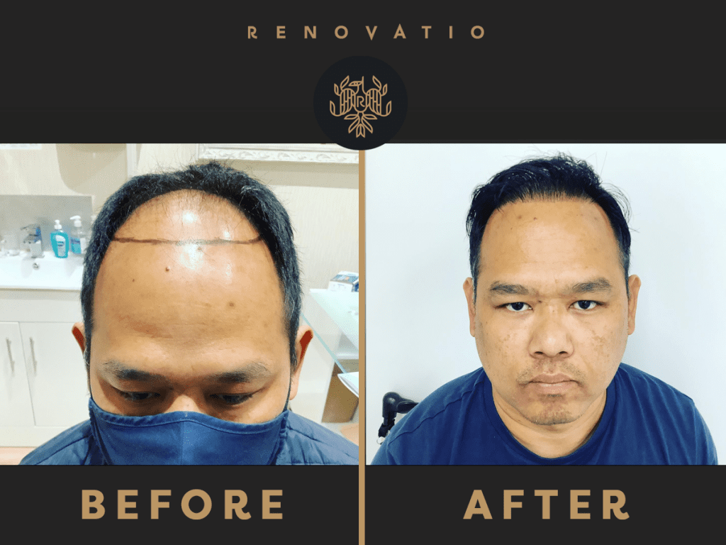 Renovatio hair transplant
