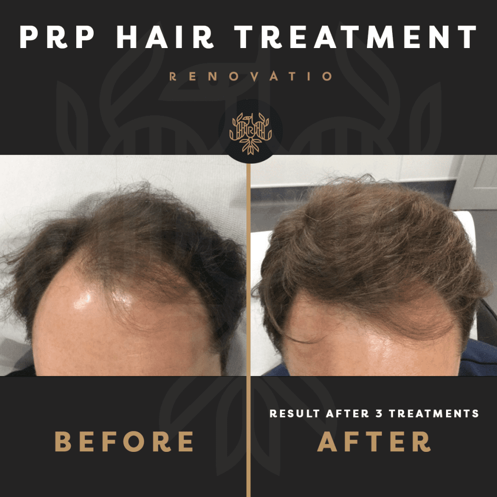 PRP treatment of a client at Renovatio Clinic 1