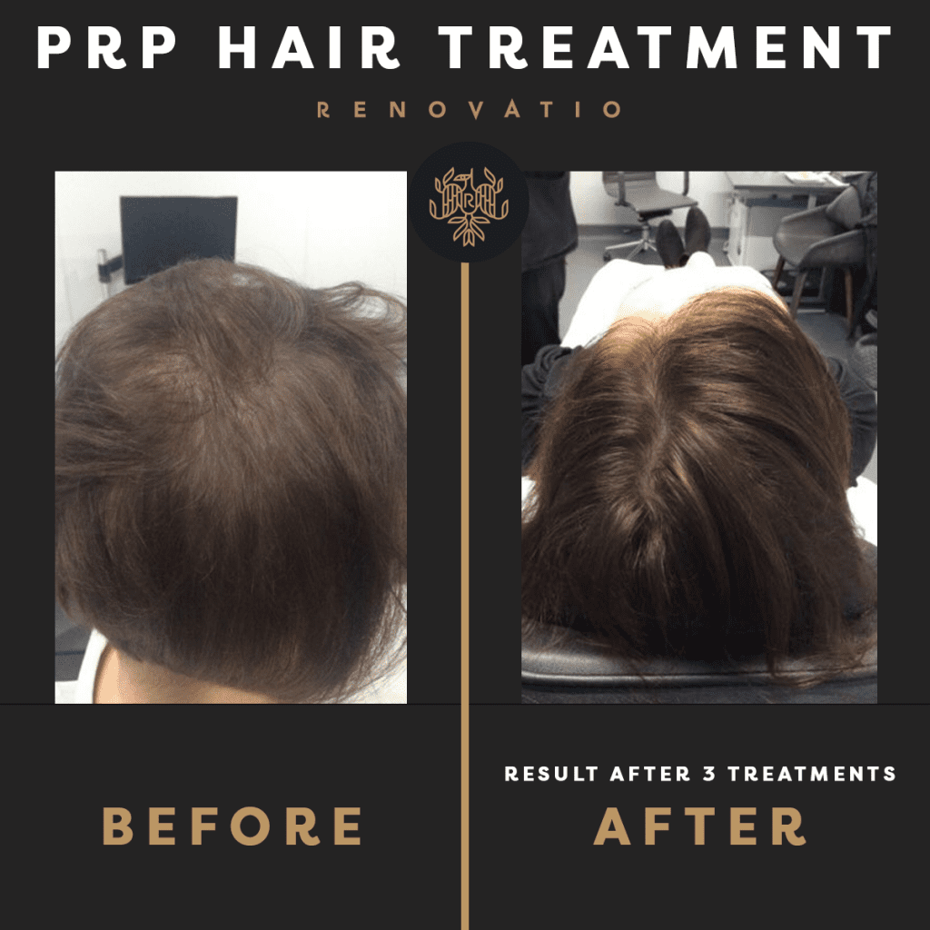 PRP treatment of a client at Renovatio Clinic female 5