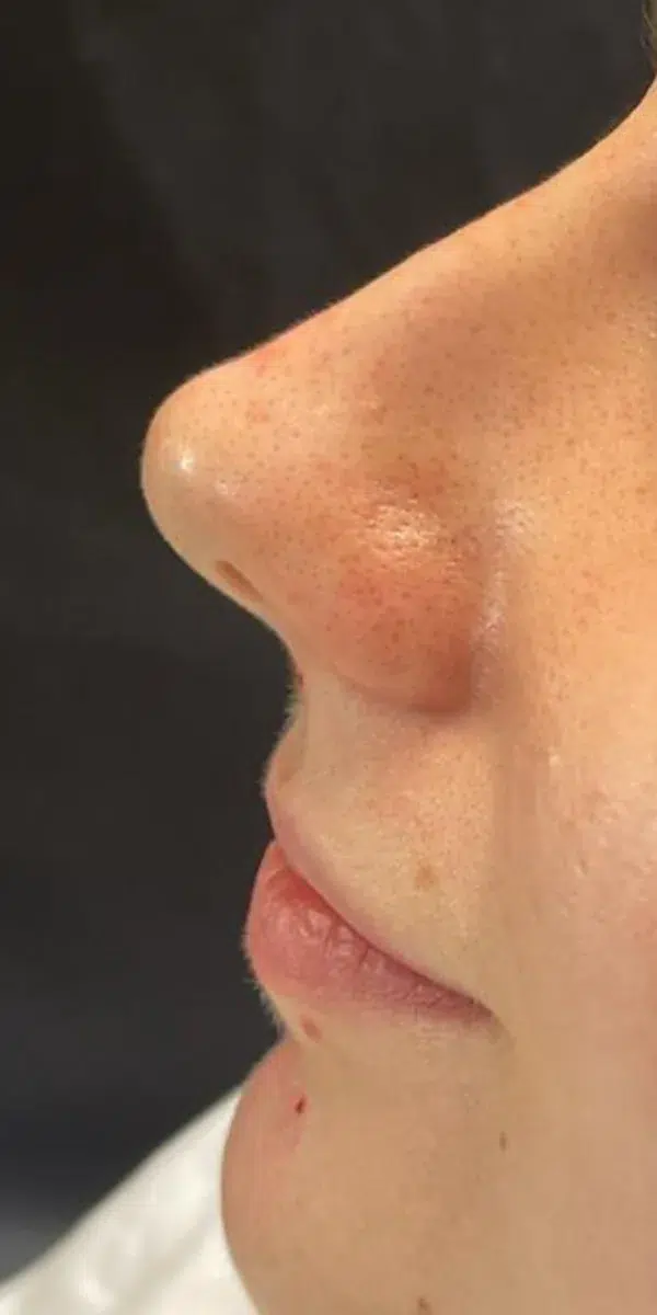 Rhinoplasty Left Side at Renovatio Clinic