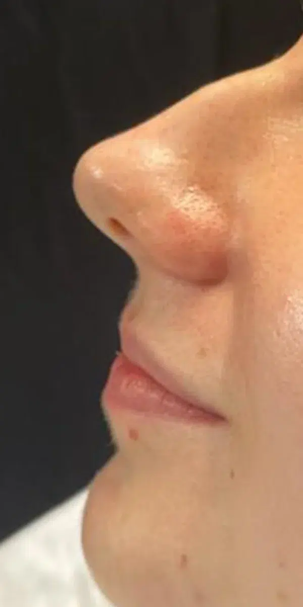Rhinoplasty Left Side Before at Renovatio Clinic