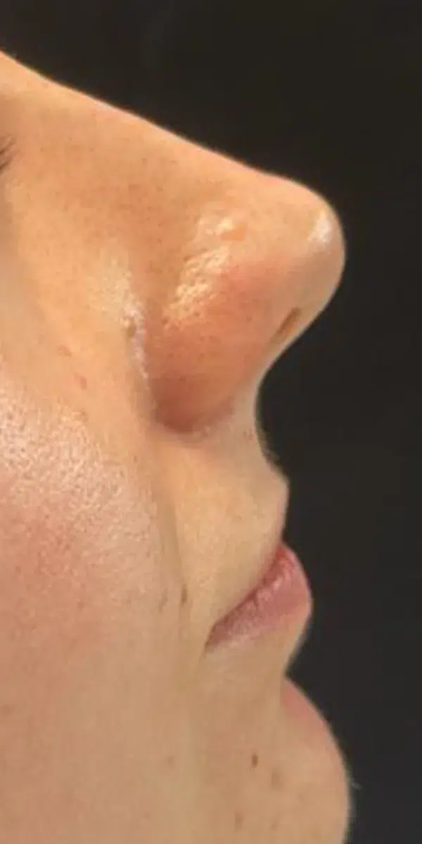 Rhinoplasty Right Side After with Renovatio Clinic