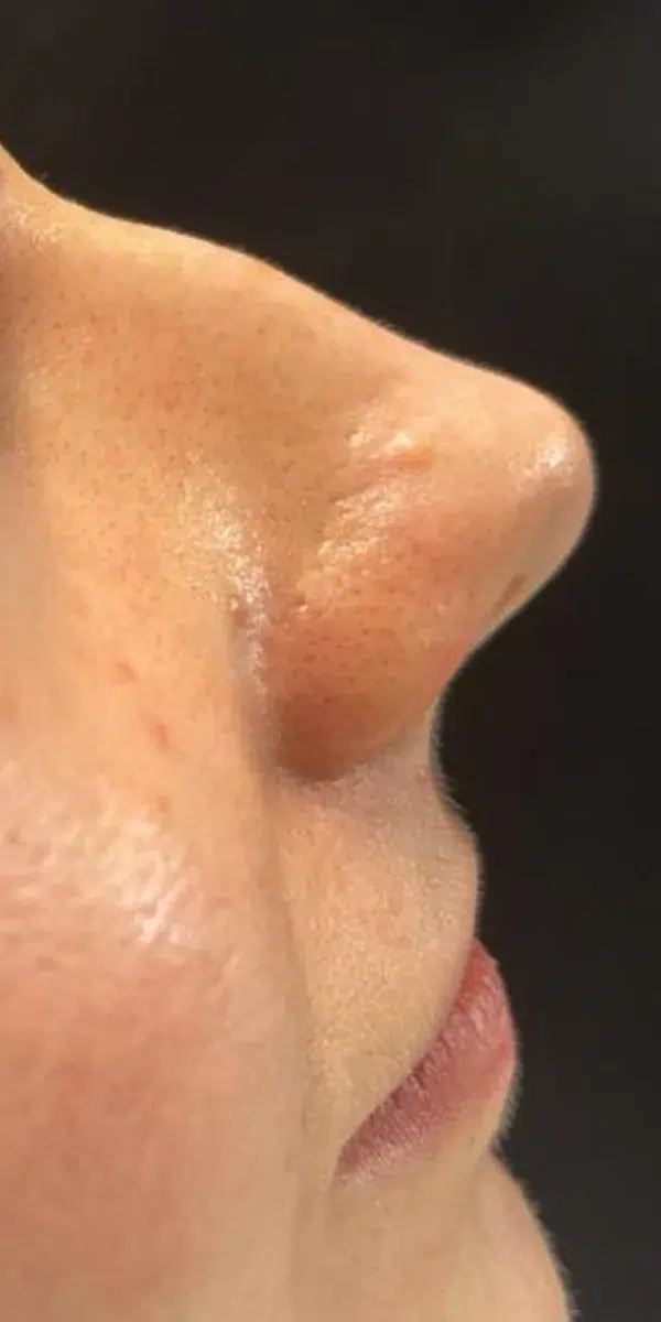 Rhinoplasty Right Side Before at Renovatio Clinic