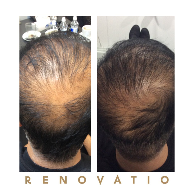 hair restoration before and after at Renovatio Clinic