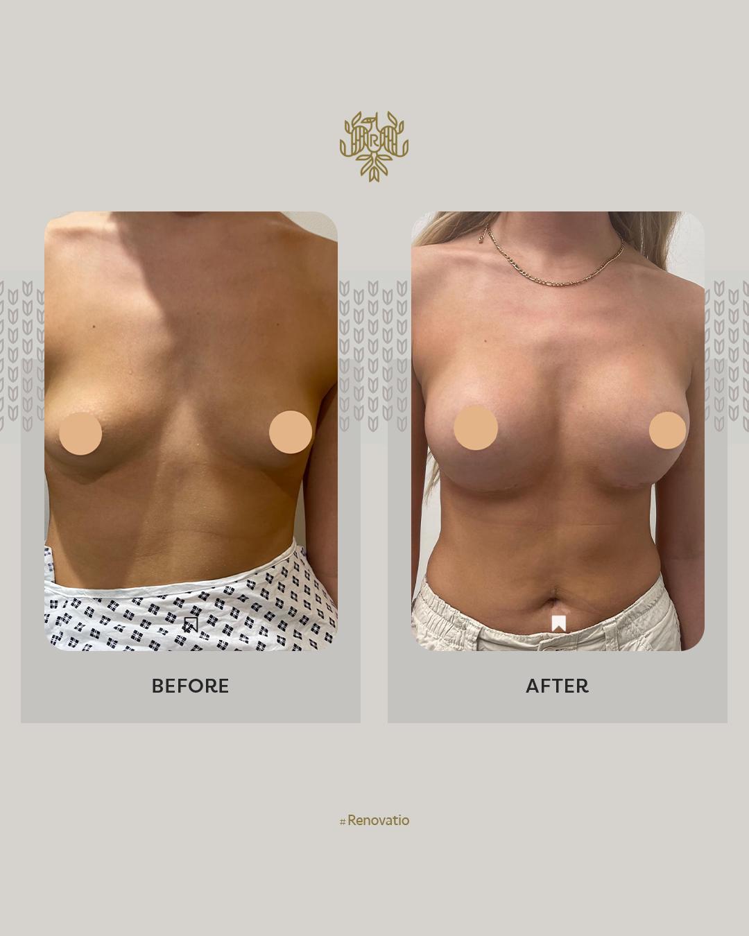 Breast Augmentation Results with Dr. Sof 1 at Renovatio Clinic