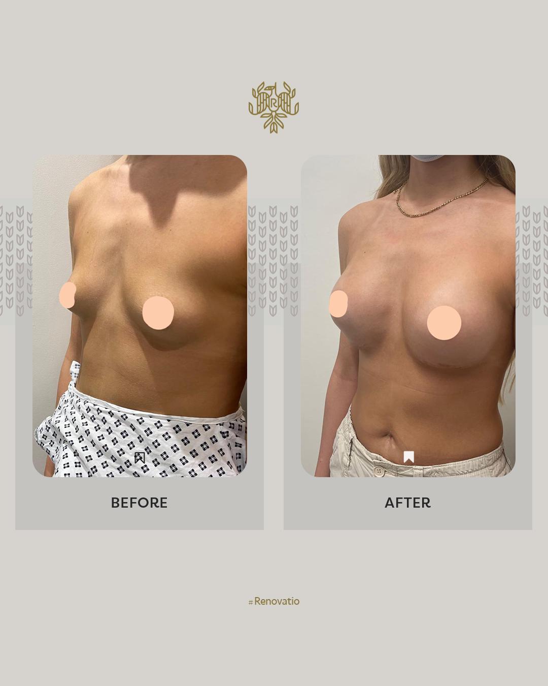 Breast Augmentation Results with Dr. Sof 2 at Renovatio Clinic