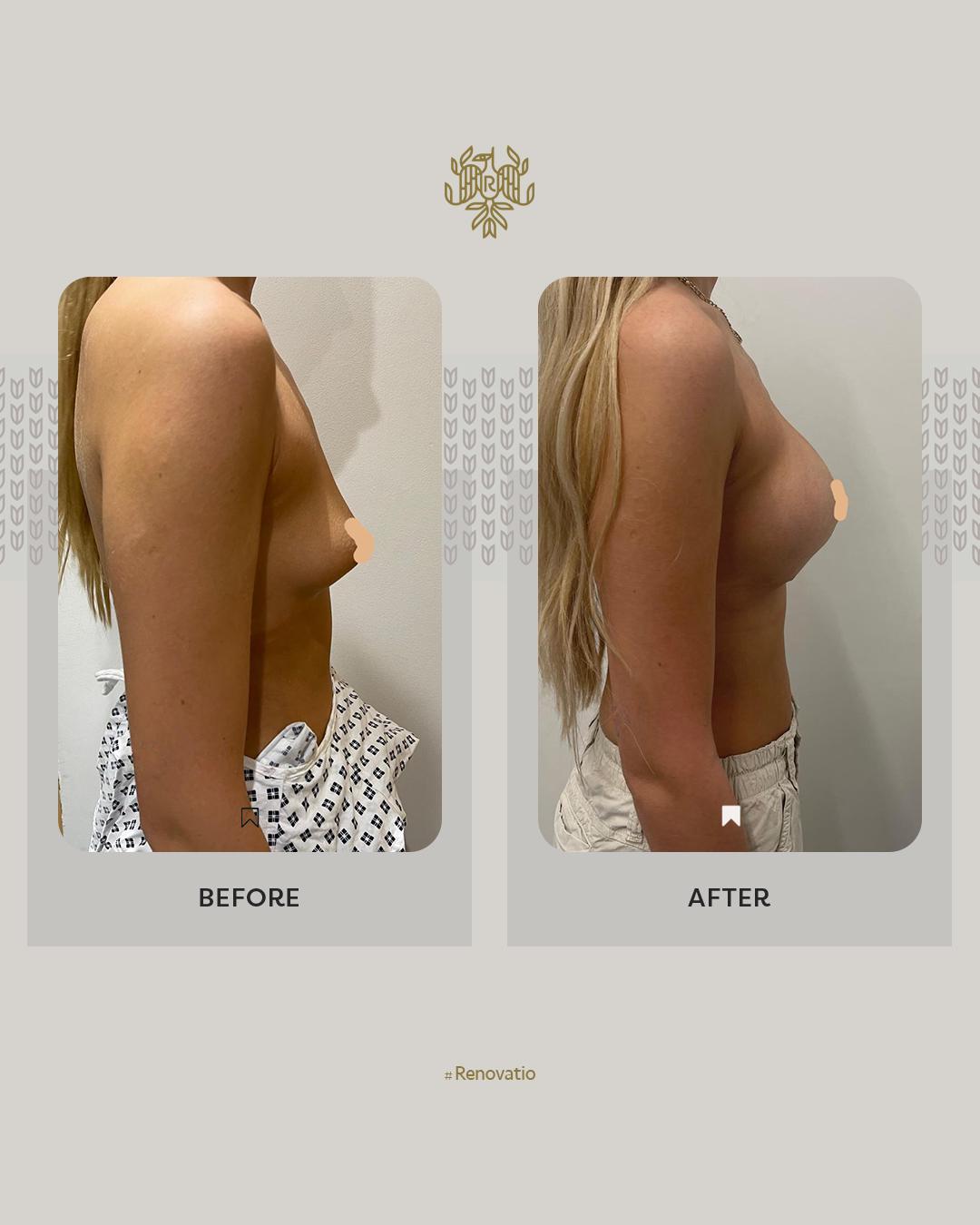 Breast Augmentation Results with Dr.Sof 3 at Renovatio Clinic