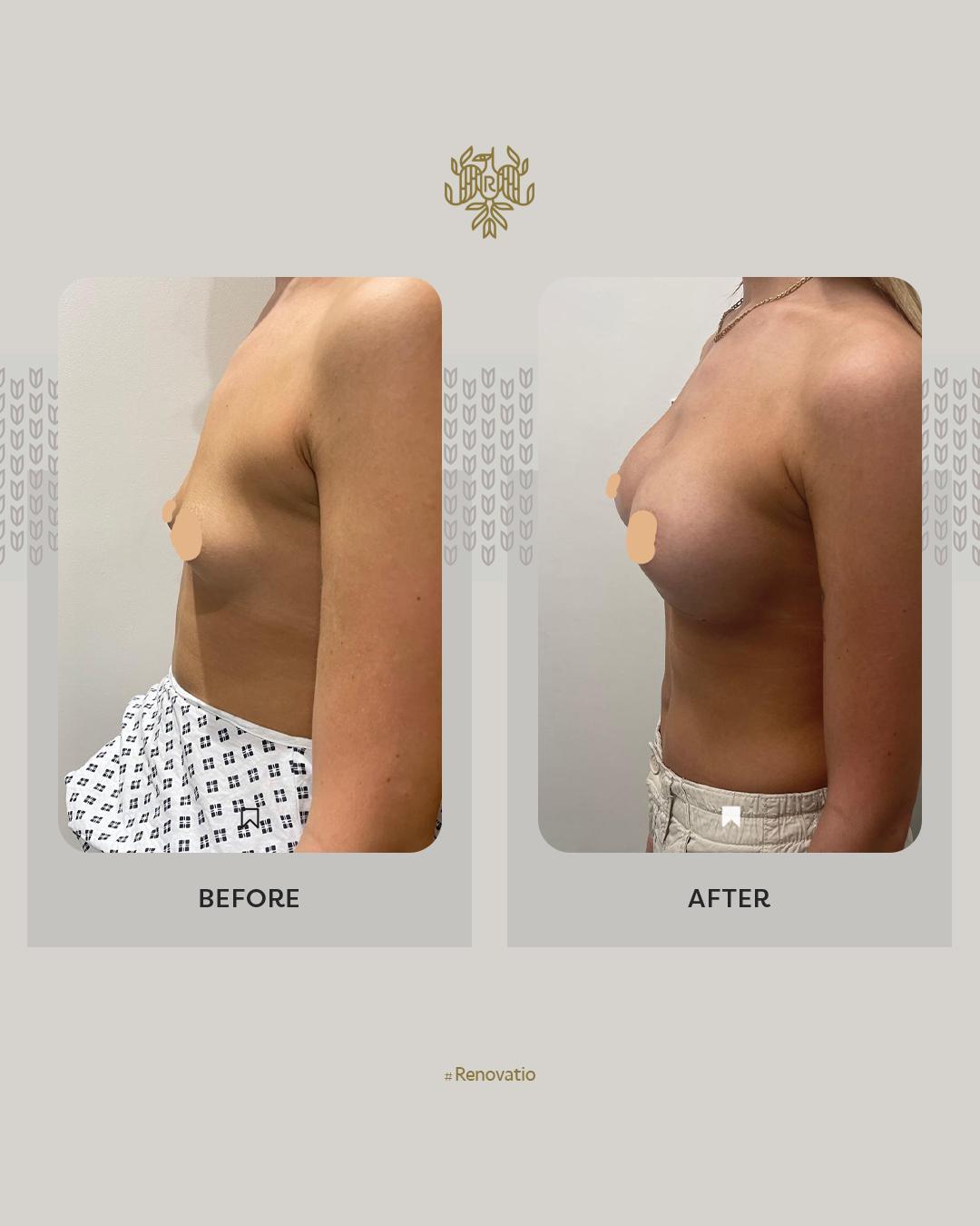Breast Augmentation Results with Dr.-Sof 4 at Renovatio Clinic