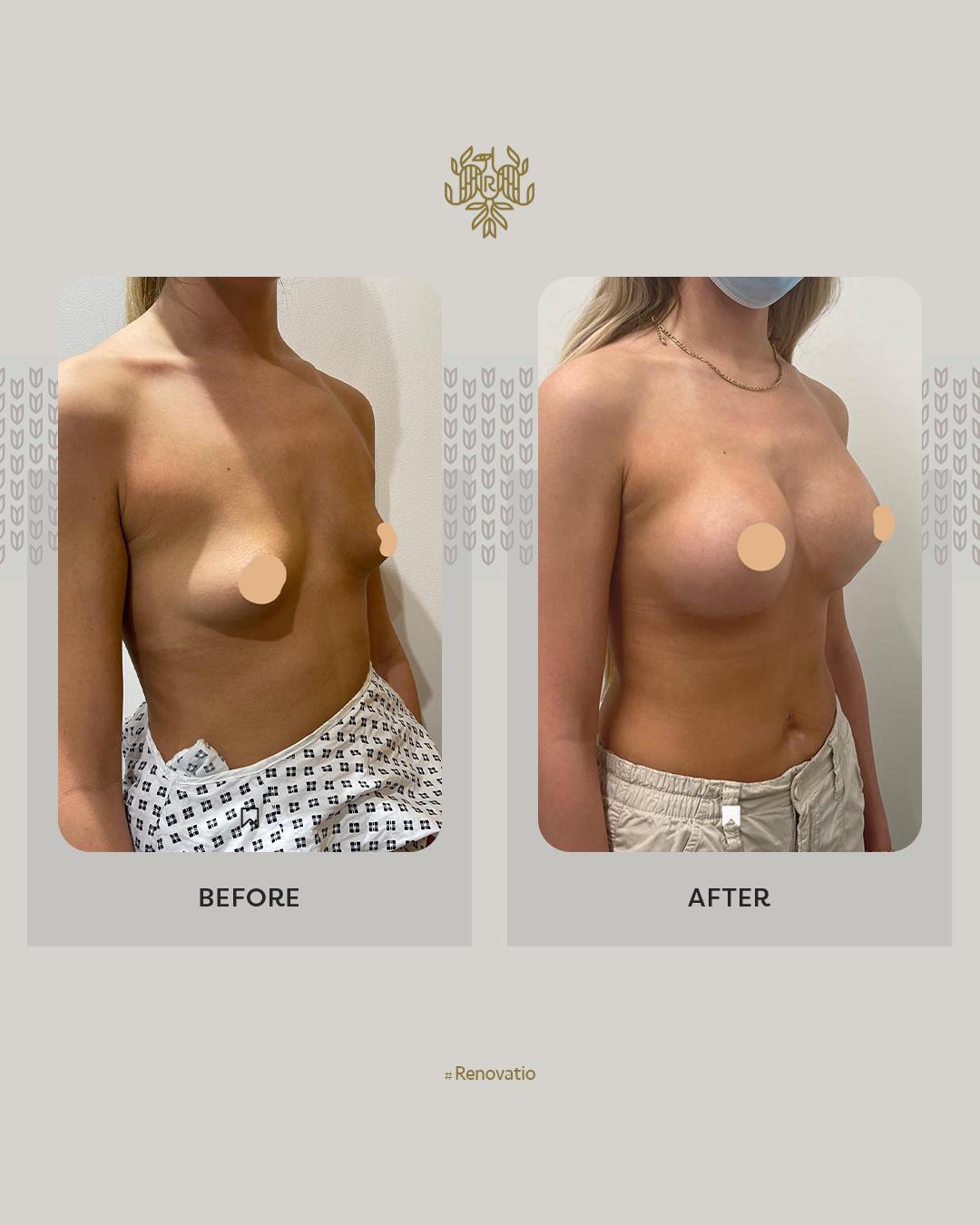 Breast Augmentation Results with Dr.Sof 5 at Renovatio Clinic