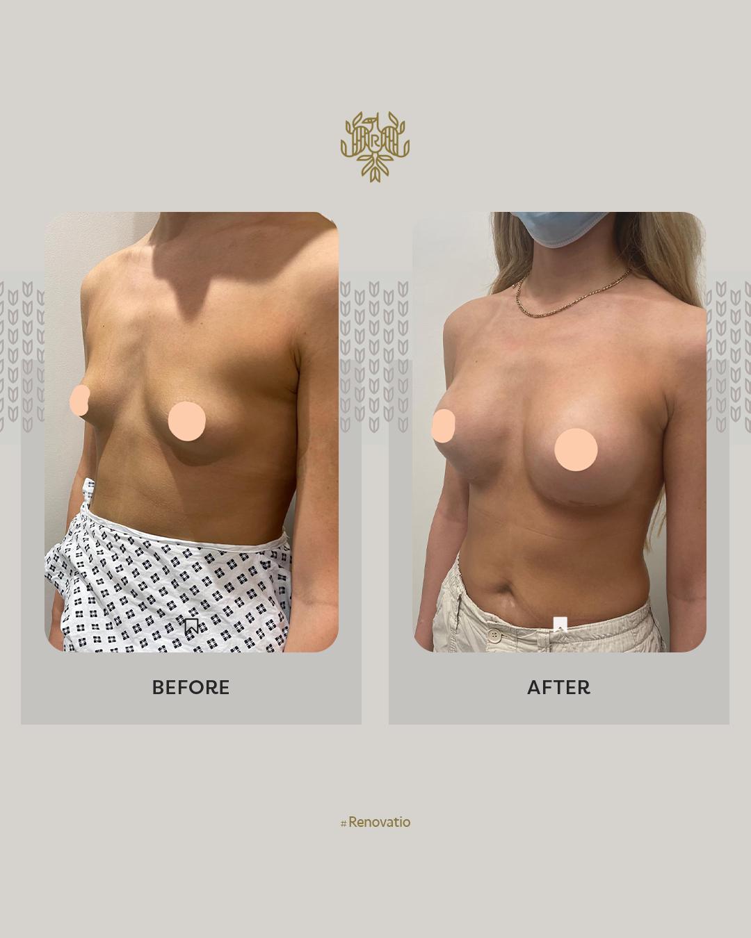 Breast Augmentation Results with Dr. Sof 6 at Renovatio Clinic