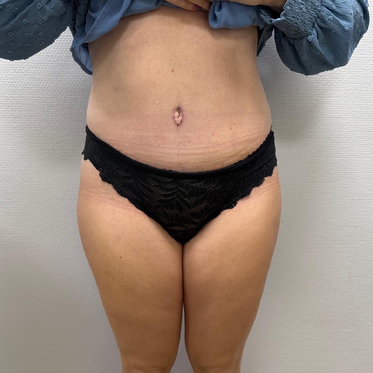 Abdominoplasty After Front Angle with Renovatio Clinic