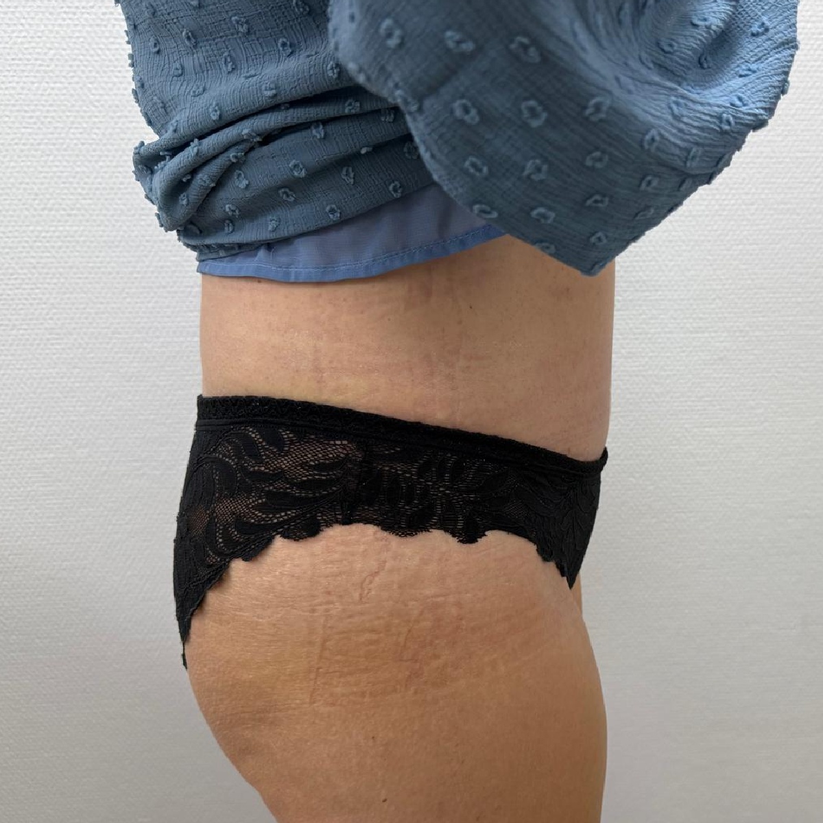 Abdominoplasty After Side Angle 2 with Renovatio Clinic