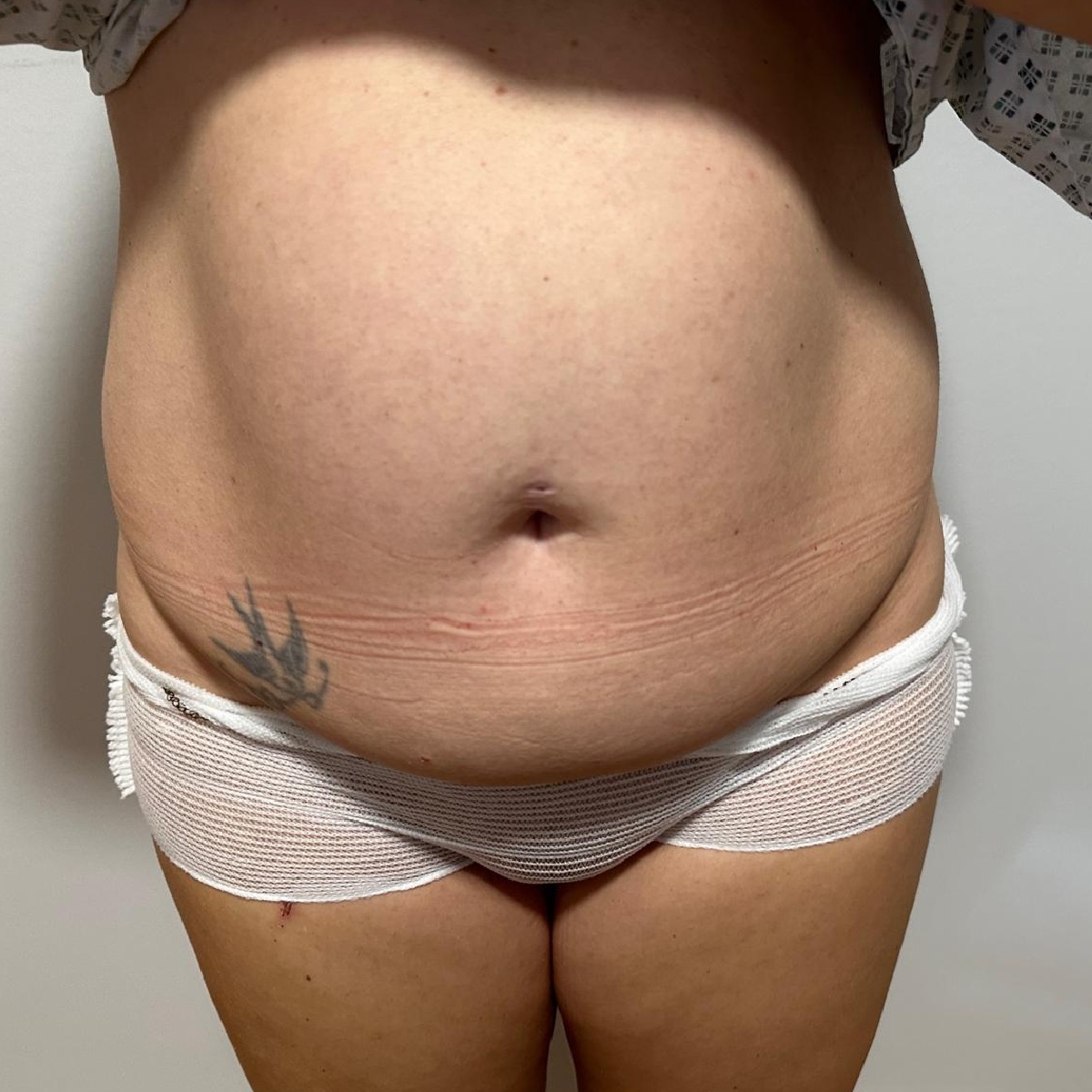 Abdominoplasty Before Front Angle with Renovatio Clinic