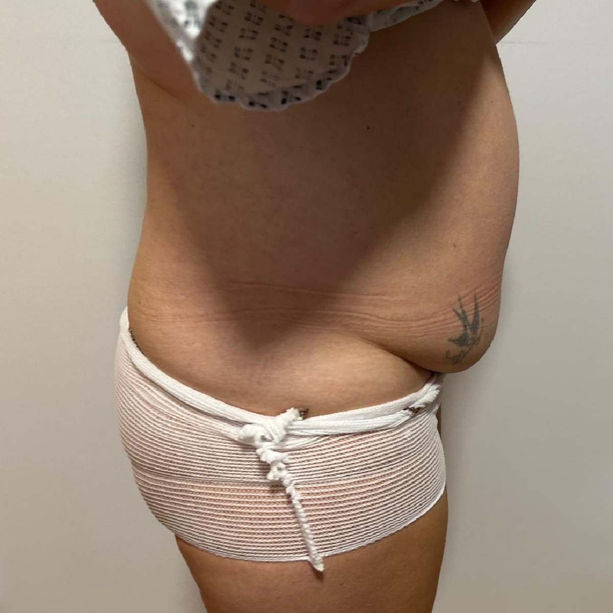 Abdominoplasty Before Side Angle 2 with Renovatio Clinic