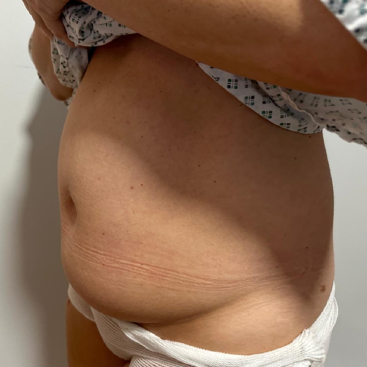 Abdominoplasty Before Side Angle with Renovatio Clinic