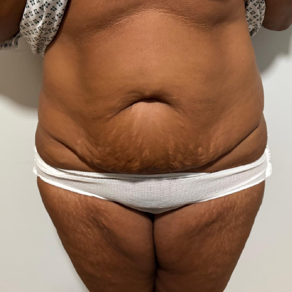 Abdominoplasty Before with Renovatio Clinic